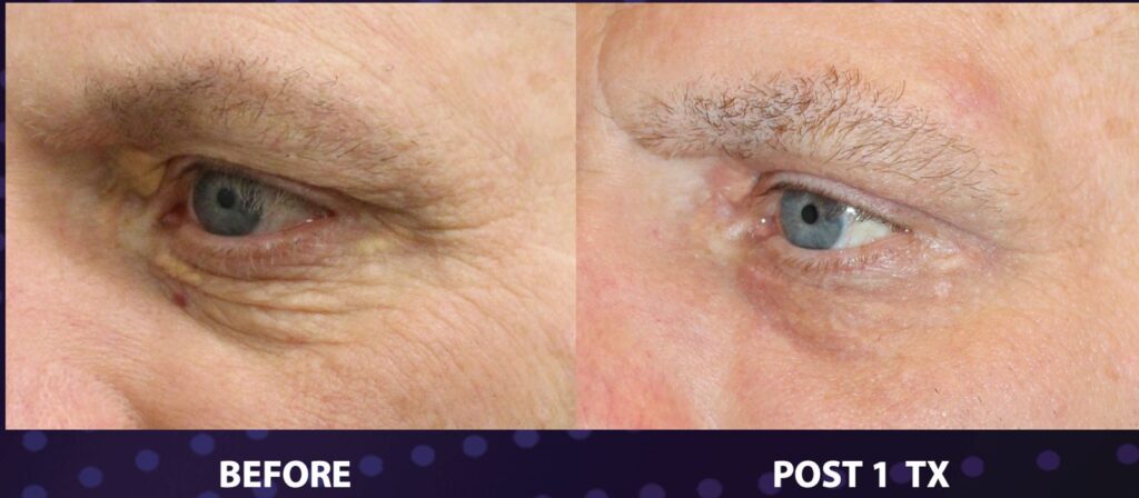 Opus Plasma Treatment & Machine in Upland CA | Alma Oasis Med Spa